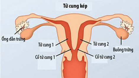 Người phụ nữ có 2 tử cung sinh bé gái nặng 2,3kg