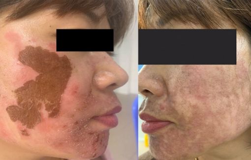 Mặt thâm loang lổ do đắp lá trầu không trị nám