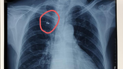 Sau mổ, bệnh nhân lưu mảnh bom gần 50 năm ở trong ngực làm kỷ niệm