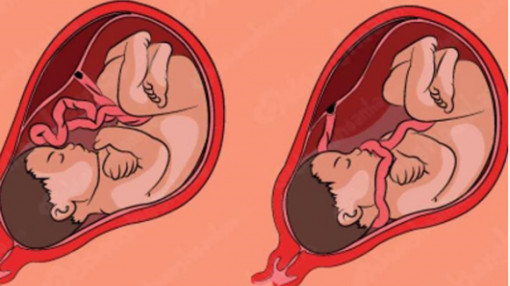 2 em bé bị ung thư do truyền từ mẹ trong lúc sinh nở