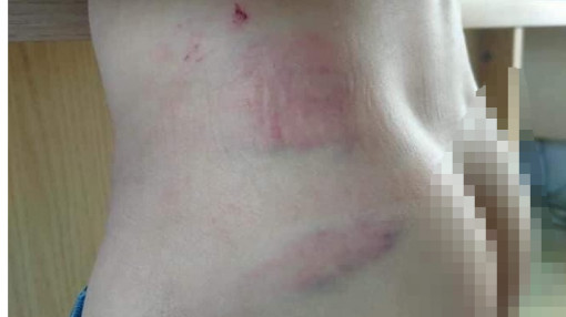 Gia Lai: Bé trai 9 tuổi bị cha ruột đánh đến nhập viện