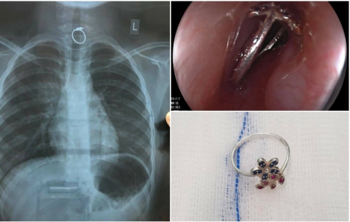 Bé gái bị hóc nhẫn đeo tay trong thực quản