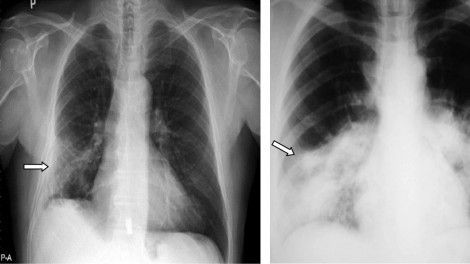 Bệnh nhân ở Hải Dương nguy kịch, phổi đông đặc sau 1 ngày phát hiện mắc COVID-19