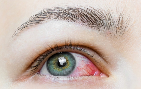 Mắc COVID-19 nặng có nguy cơ mù lòa
