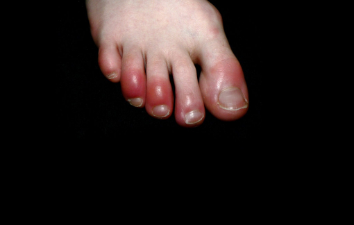 “Ngón chân COVID” có phải bệnh nguy hiểm?