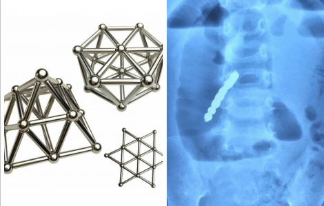 Bé gái 2 tuổi thủng ruột do nuốt 7 viên bi nam châm xếp hình