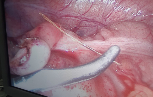 Xương cá đâm thủng ruột thừa