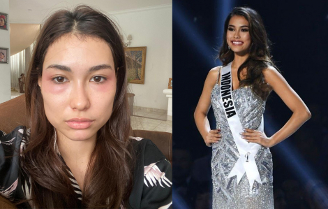 Hoa hậu Indonesia kiện bệnh viện thẩm mỹ vì mặt trông như bị đánh