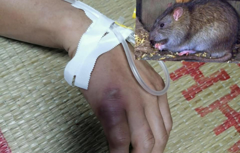 Bệnh nhân nổi hạch toàn thân do chuột cắn