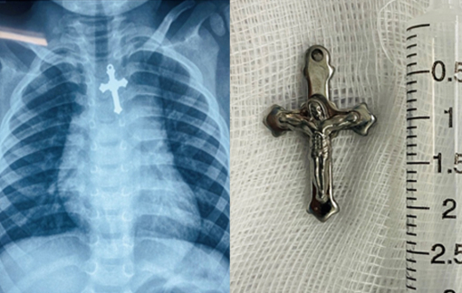 Em bé không ăn được, đi khám phát hiện mặt dây chuyền trong thực quản