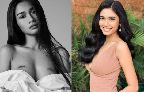 2 vết sẹo to trên ngực Hoa hậu Hoàn vũ Myanmar và câu chuyện phía sau