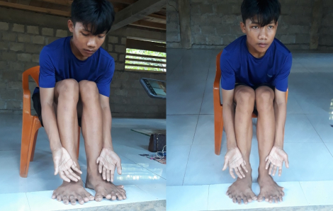 Kỳ lạ nam sinh người Vân Kiều ở Quảng Trị có đến 26 ngón tay, chân