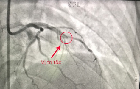 Tái thông mạch vành cứu phụ nữ 26 tuổi bị nhồi máu cơ tim