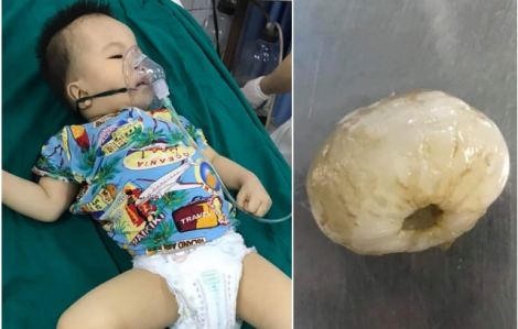 Em bé 15 tháng tuổi tím tái toàn thân sau khi ăn một quả vải