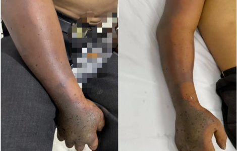 Thanh niên 27 tuổi hoại tử tay do chữa rắn cắn bằng lá cây