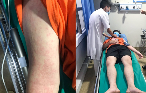 Sốc phản vệ nặng sau khi ăn món "đặc sản" từ mối