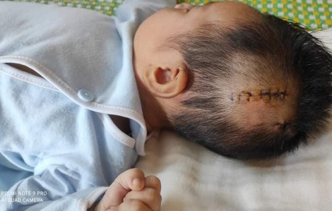 Da vàng, thóp căng phồng, bé gái 2 tháng tuổi được phát hiện xuất huyết não