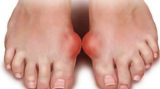 Mắc bệnh gút vì uống trà sữa trân châu