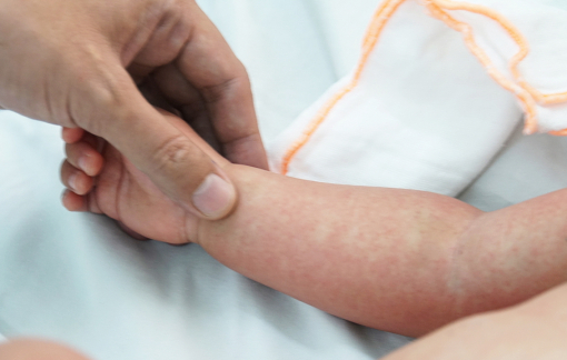 Nhiều trẻ sốt xuất huyết nặng do chậm vào viện vì cha mẹ ngại dịch