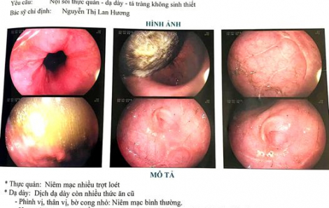 Bé 5 tuổi uống nhầm chén axit bình ắc quy