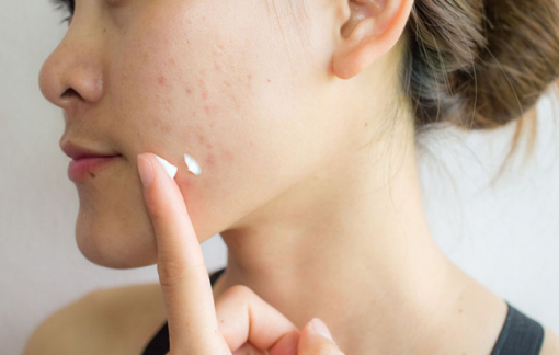 Cùng Danhgiatot lựa chọn loại kem trị mụn hiệu quả