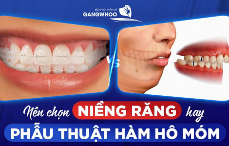 BVTM Gangwhoo: Nên chọn niềng răng hay phẫu thuật hàm hô?