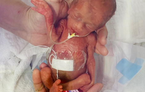 Kỳ tích cứu sống bé gái sinh non nặng 400gr, nhỏ như chiếc xi lanh