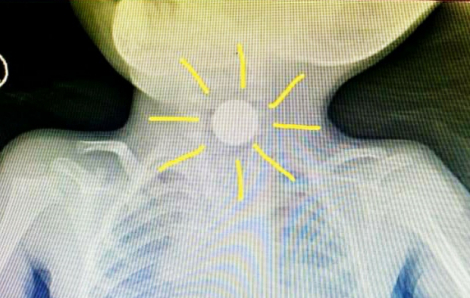 Nuốt viên pin cúc áo trong đồ chơi, bé trai 3 tuổi bị bỏng thực quản