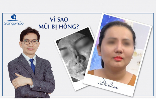 Hậu quả của nâng mũi quá cao