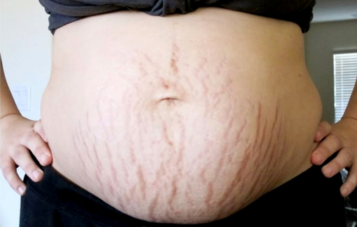 Nỗi ám ảnh mang tên rạn da