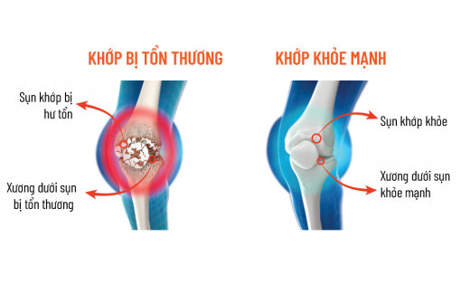 Chăm sóc xương khớp đúng cách để tận hưởng cuộc sống
