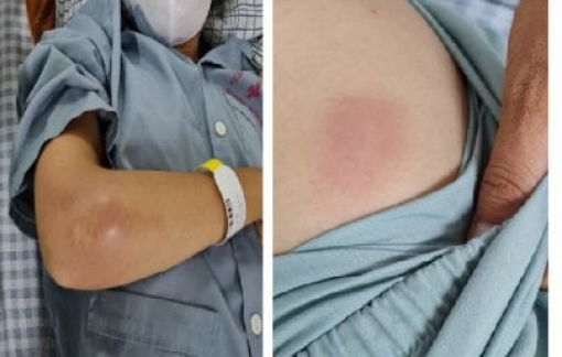 Khó thở, sốt cao, nữ bệnh nhân bất ngờ phát hiện bị nhiễm vi khuẩn ăn mòn cơ thể Whitmore