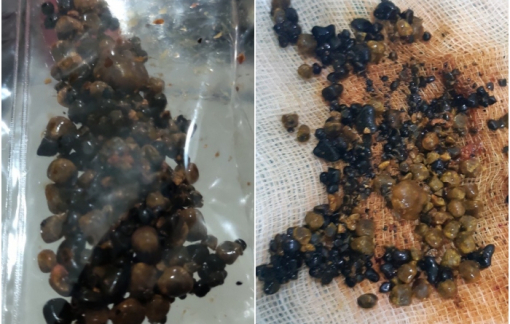 Gắp 200 viên sỏi từ túi mật người phụ nữ 29 tuổi