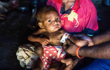 Tình trạng trẻ em thấp còi gia tăng tại Thái Bình Dương