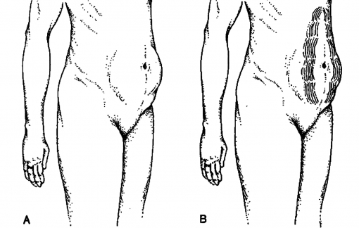 Giảm eo bằng chỉ siêu hủy mỡ, có siêu tốc như quảng cáo?
