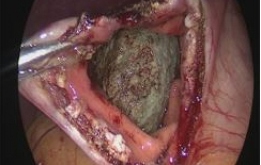 Người phụ nữ bị tắc ruột do ăn quả hồng