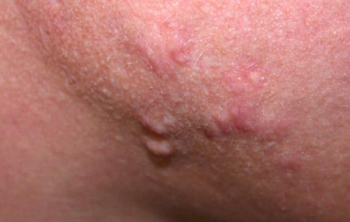 Mụn viêm là gì? Có bao nhiêu loại mụn viêm?