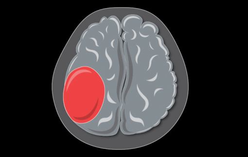 Xuất huyết não là gì? Có nguy hiểm không?