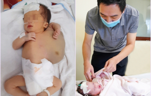 Em bé vừa chào đời đã mang trên người khối u khổng lồ