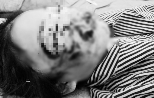 Bé 10 tuổi bị chó đang chửa cắn rách mặt