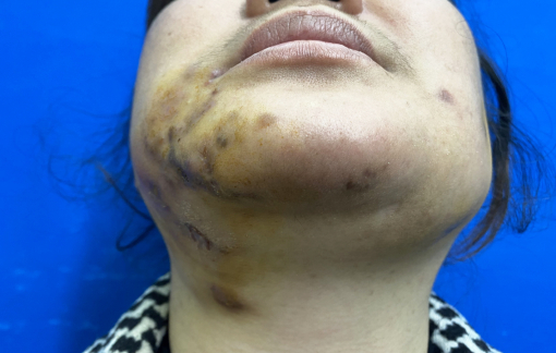 Tiêm filler làm đẹp cuối năm: Gặp nơi không phép, tai biến chực chờ