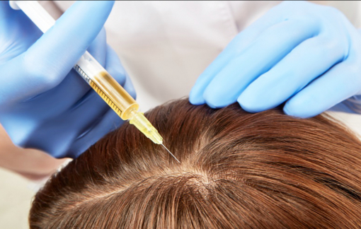 Cấy biotin không phải là “thần dược” mọc tóc