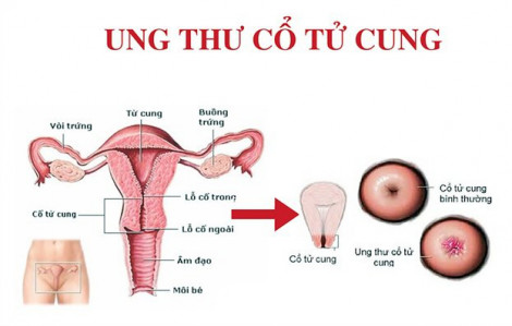 Đã quan hệ tình dục có cần tiêm phòng ung thư cổ tử cung?