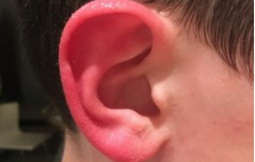 Tai tự dưng đỏ, nóng rát không hiểu vì sao?