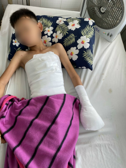 Khánh Hòa: Cấp cứu một trẻ bị đa chấn thương do pháo nổ