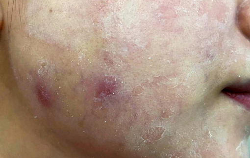 Biến chứng vì làm đẹp bằng tiêm thuốc tan mỡ dạo