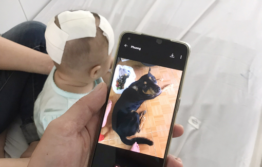 Chó cưng cắn bé gái 6 tháng tuổi dập não