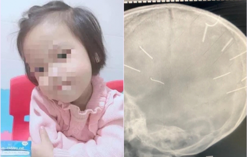 Bé 3 tuổi bị đóng đinh vào đầu đã tử vong