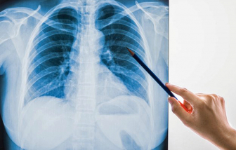 Có nên chụp X-quang vì lo tổn thương phổi hậu COVID-19?