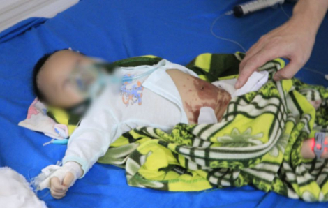 Bé sơ sinh nhập viện cấp cứu do đắp tỏi vào bụng chữa COVID-19